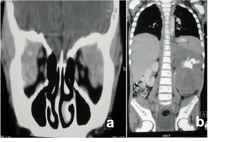 File:Neuroblastoma.png