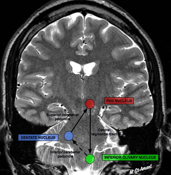 File:Triangle-of-guillain-and-mollaret (1).jpg