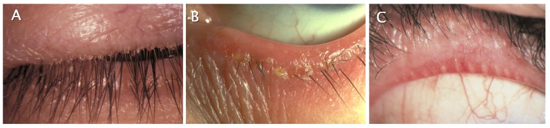 File:Forms of Blepharitis.jpg