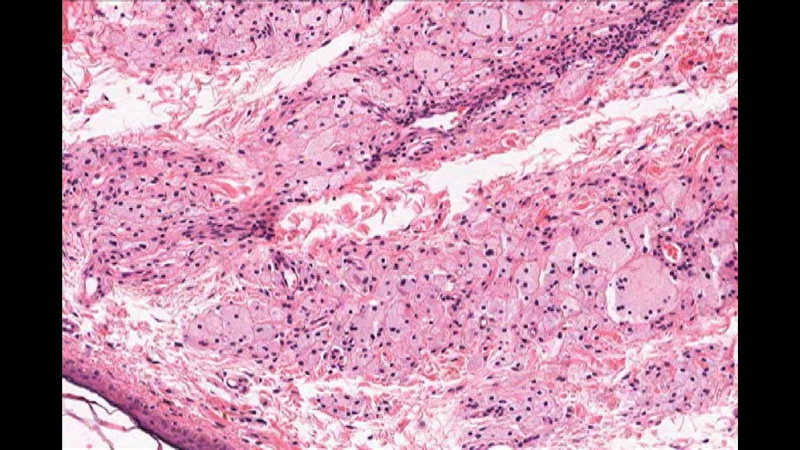 File:Xanthelasma Cells.jpg