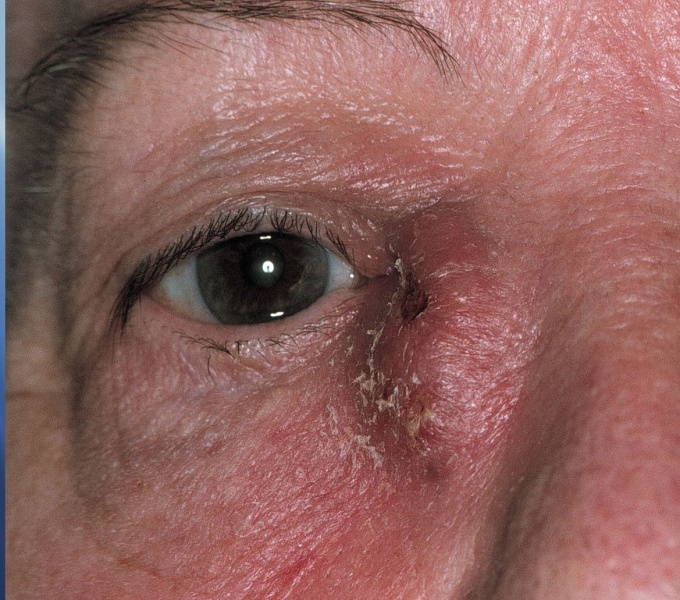 File:Dacryocystitis.jpg