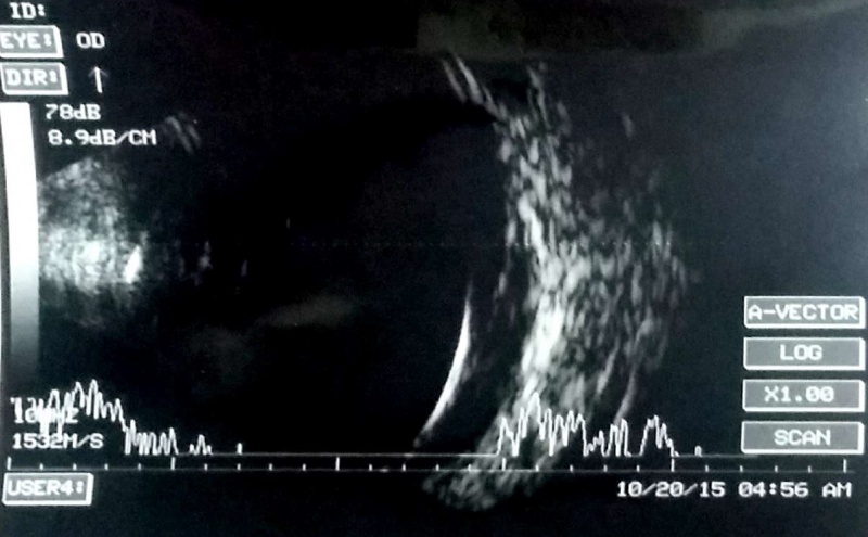 File:Koushik silicone oil filled eye.jpg