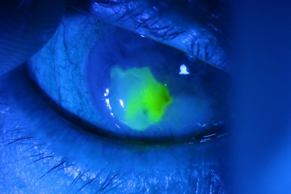 Methamphetamine-Induced Keratitis - EyeWiki