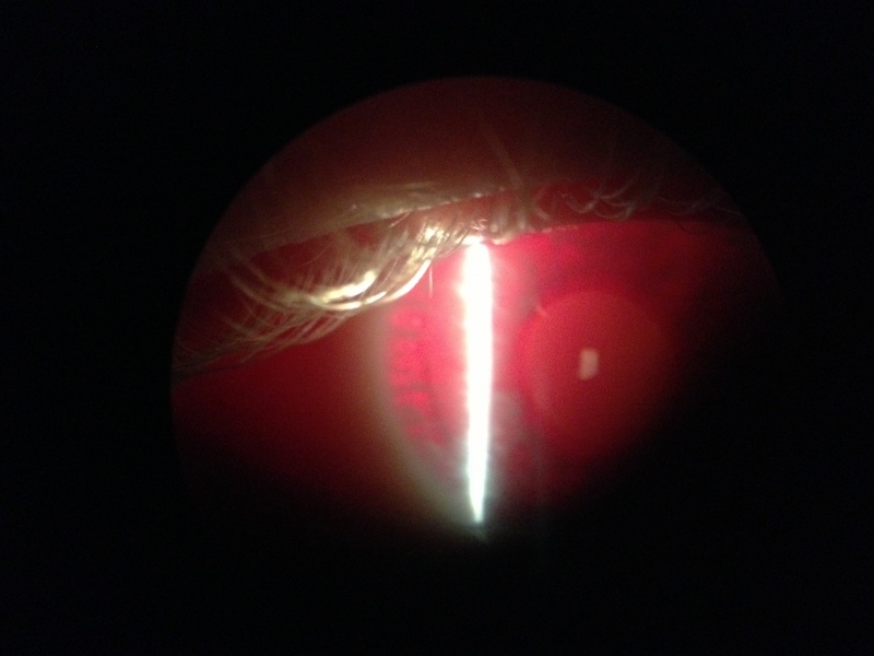 File:Right eye severe transillumination.jpg
