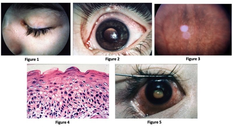 File:Xerophthalmia .jpg