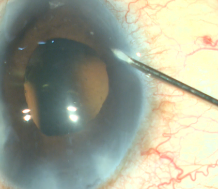 Ab Interno Trabeculectomy and Trabeculotomy - EyeWiki