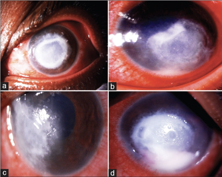 File:Fig 2 Eyewiki.png