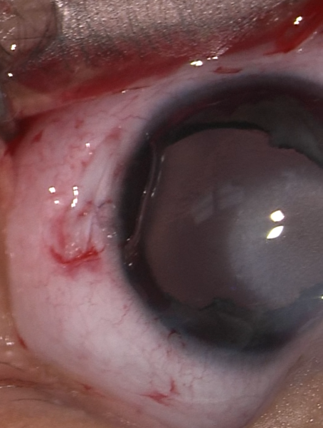 File:Peters enlarged visual axis.png