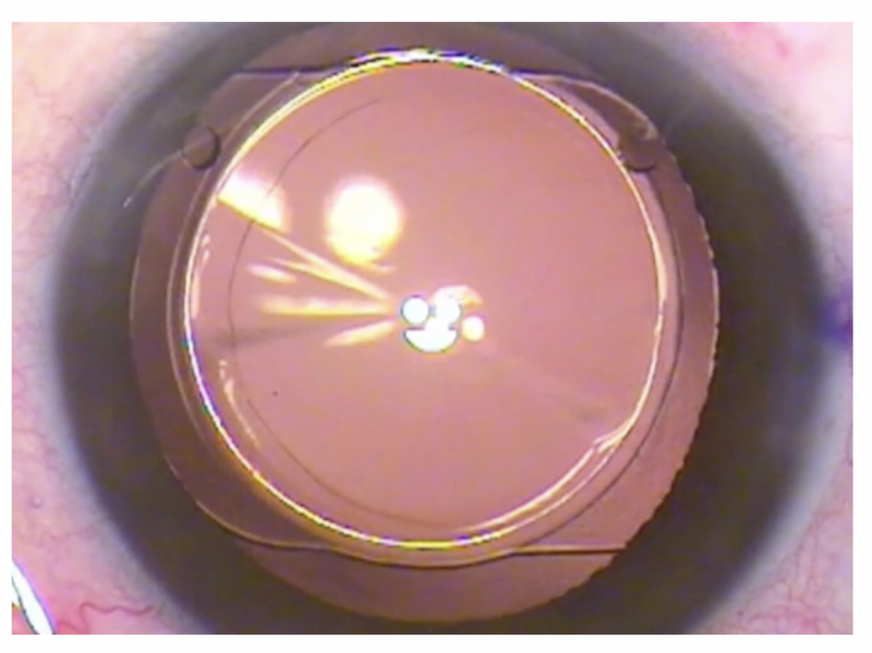 File:AUTOFOCUS PRO IOL PIC DILATED.png