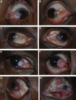 Photographs of a pterygium and various grades of ocular surface squamous neoplasia: pterygium (A), conjunctiva intra-epithelial neoplasia (CIN) 1 (B), CIN 3 (C), carcinoma in situ (D), squamous cell carcinoma (SCC) grade 1 (E), SCC grade 2 (F), SCC grade 3 (G), and SCC with orbital invasion (H).