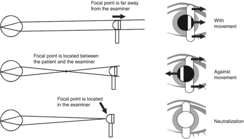 File:Retinoscope motion.png