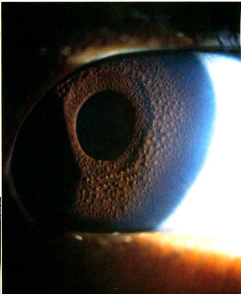 File:S diffuse iris nodule.png