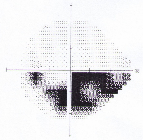Primary Open-Angle Glaucoma - EyeWiki