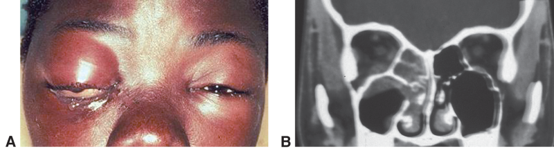 File:Bacterial orbital cellulitis.png