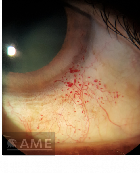 File:Conjunctival telangiectasia.png