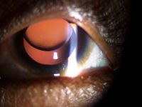 Ectopia lentis (EL) is a major criteria for the diagnosis of Marfan syndrome, it may vary from an asymptomatic mild displacement to a significant subluxation that places the equator of the lens in the pupillary axis. Retroillumination image of ectopia lentis.