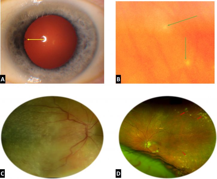 File:Ocular manifestations of sarcoidosis.jpg