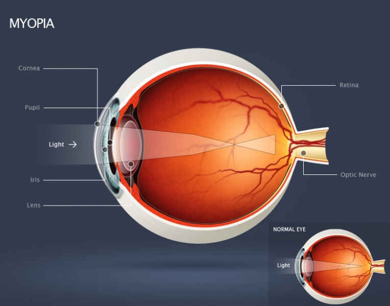 File:Diagram-myopia.jpg