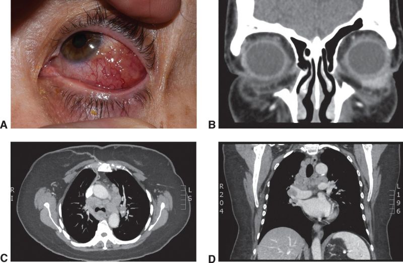 File:Sarcoidosis orbit chest AAO.jpg