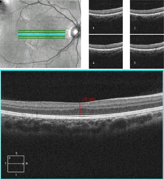 File:Foveal hypoplasia OCT.JPG