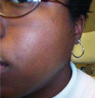 Heerfordt syndrome: sarcoid parotitis, lymphadenitis, and uveitis. This 19-year-old woman had firm, nontender glandular and lymphadenopathic edema to the left side of her face with bilateral panuveitis.