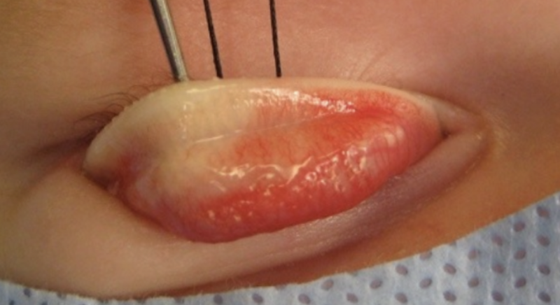 File:Tarsal kink.png