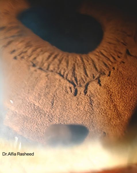 File:IRIS CYST Dr.Alfia.jpg