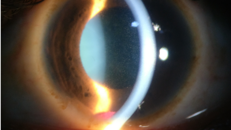 File:Traumatic-hyphema.png