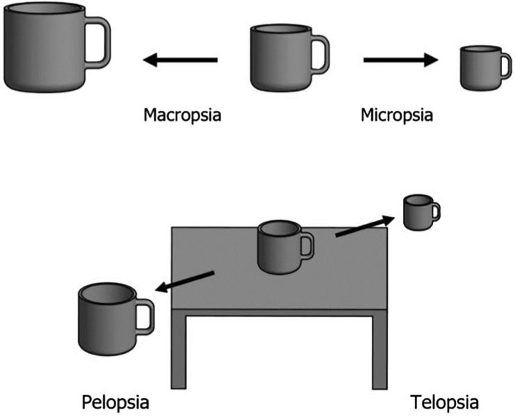 File:AA0 Metamorphopsia migraine.jpeg