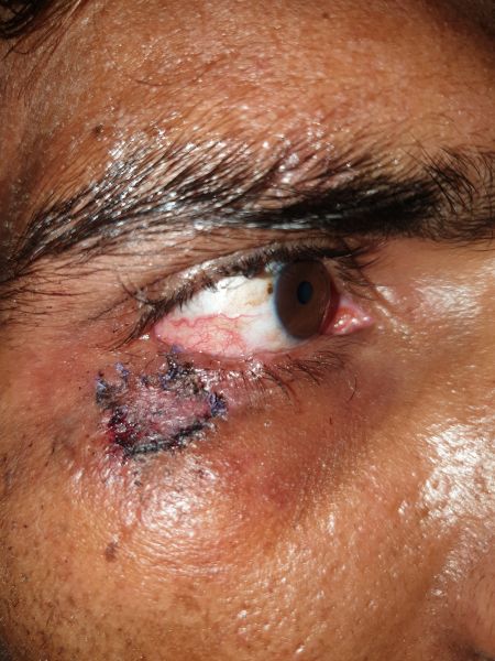 File:Cicatrical ectropian post ftsg.jpg.jpg