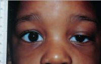 Measurement of ptosis in primary gaze with ruler adjacent to frontal plane of face (MRD1); OD is 4 mm, OS is 1 mm.