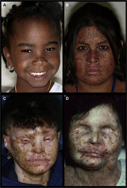 File:Xeroderma Pigmentosum.jpg