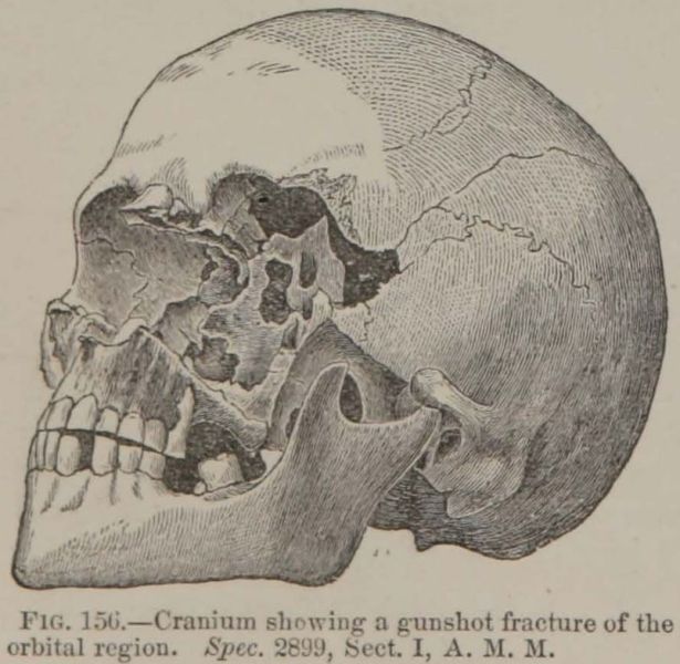 File:Civil War soldier gunshot fracture.JPG
