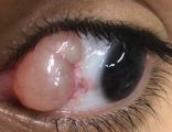 Figure 2A. Conjunctival inclusion cyst after blunt trauma. (Courtesy of Maria Emília Xavier dos Santos Araújo, PhD. Hospital of State Civil Servant, São Paulo [IAMSPE-SP].)