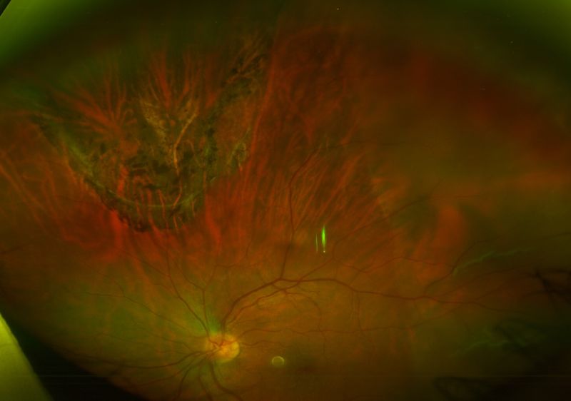 File:Delimiting Laser Photocoagulation.jpg