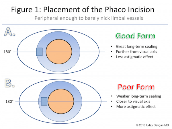 Posterior Capsular Rent - EyeWiki