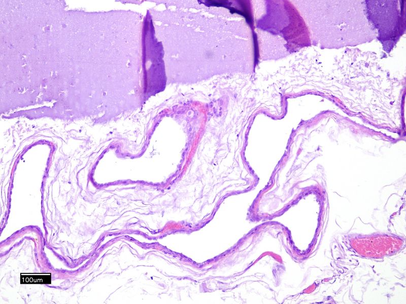 File:Serpiginous cavity of WGDC.jpg
