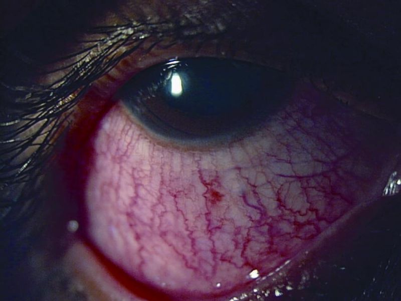 File:Scleritis.jpg