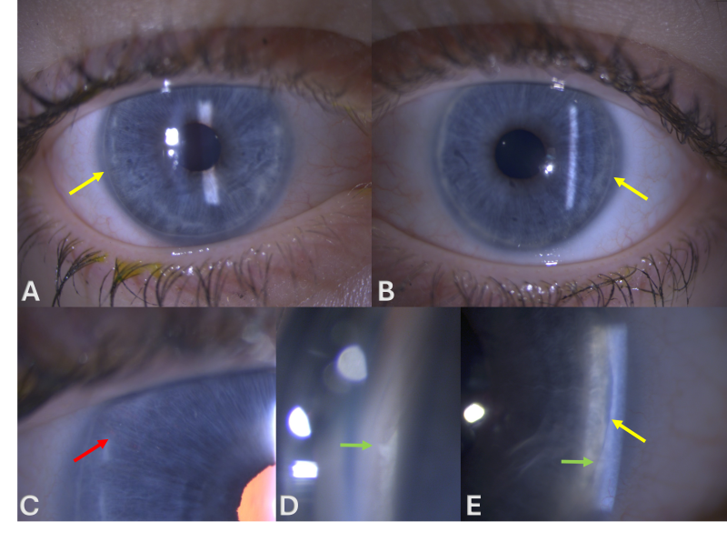 File:Axenfeld-Rieger syndrome.png