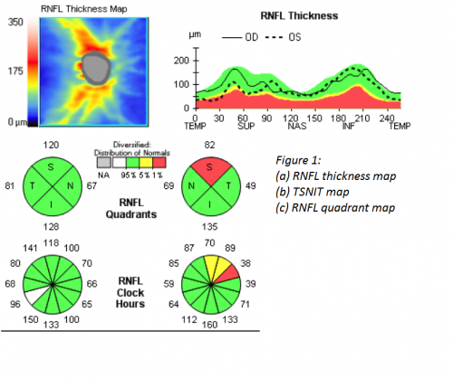 Spectral Domain Optical Coherence Tomography in Glaucoma - EyeWiki
