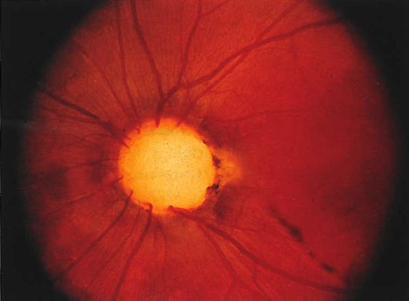 File:AA0 nerve coloboma 2019.jpg