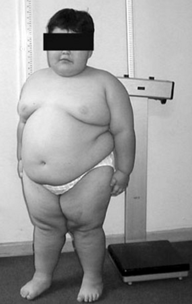 File:Prader-Willi syndrome.png