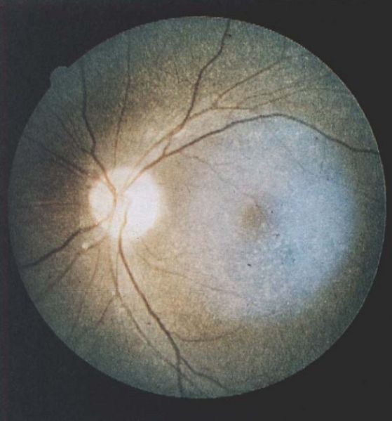 File:Cystinosis.jpg