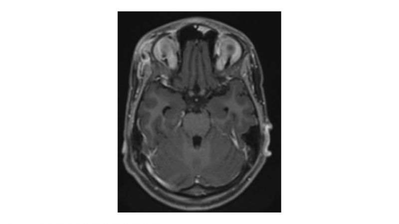 File:Coccidiodomycosis-Osteomyelitis.jpg