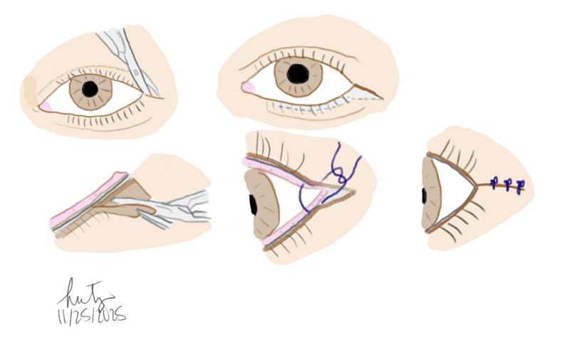 File:Lateral Tarsal Strip.png