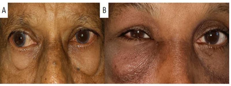 File:Allergic edema.jpg