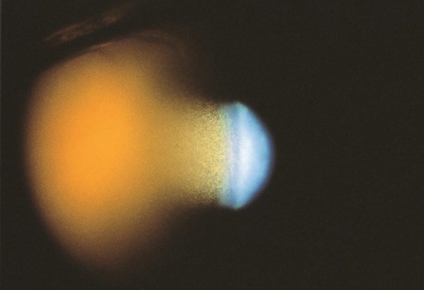 Ocular Trauma: Acute Evaluation, Cataract, Glaucoma - EyeWiki