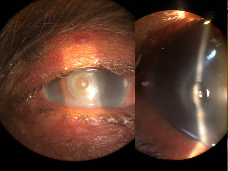 File:Descematocoelee.JPG.jpg