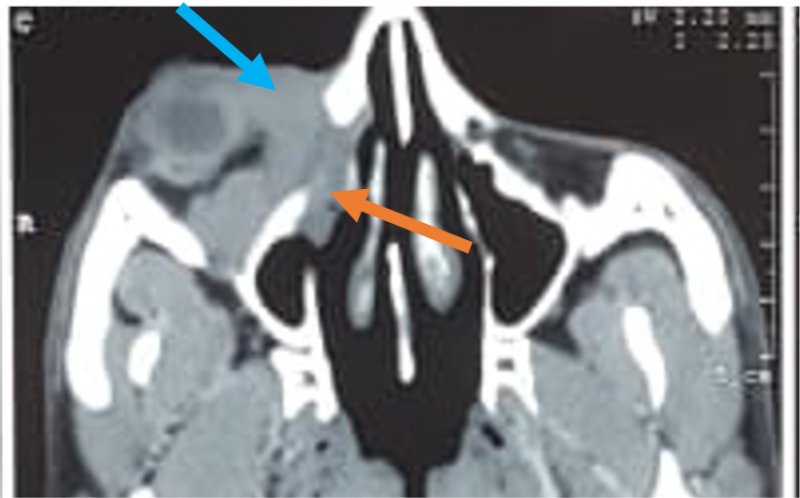 File:Invasive Sino-orbital Aspergillosis.png