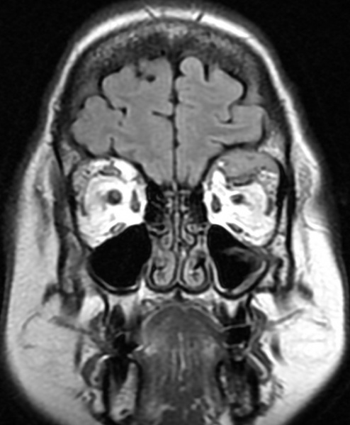 File:Orbital plasmacytoma MRI .JPG